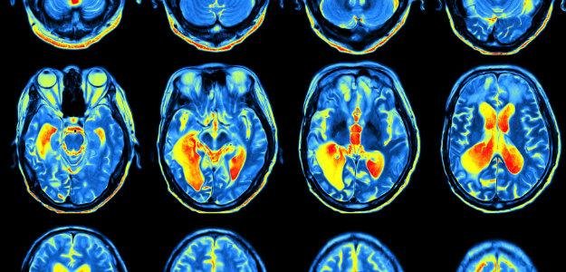 Estudo tenta confirmar forma espec&iacute;fica de identificar a doen&ccedil;a