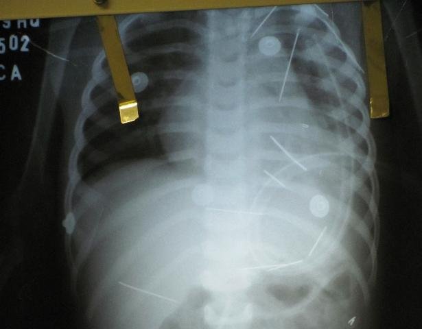 M&eacute;dicos far&atilde;o cirurgia para retirar agulhas de crian&ccedil;a