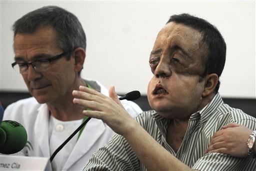 Homem que teve rosto transplantado sai do hospital, na Espanha