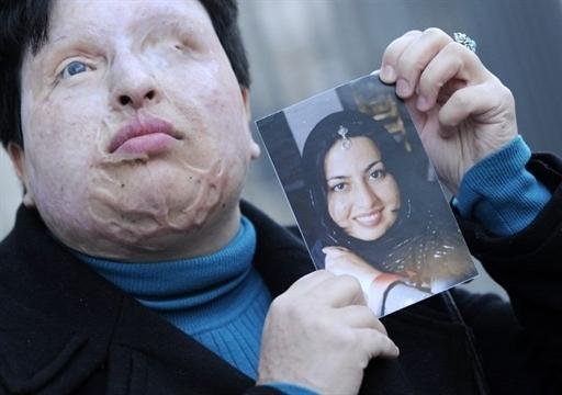 Ameneh Bahrami mostra foto antes de ter sido desfigurada pelo &aacute;cido