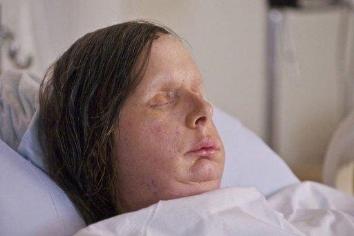 Hospital divulga foto de primeira americana a receber transplante de rosto