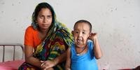 Doença misteriosa faz bengalês de 4 anos parecer idoso