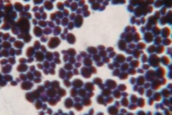 Quatro pacientes n&atilde;o resistiram a complica&ccedil;&otilde;es da Candida Auris