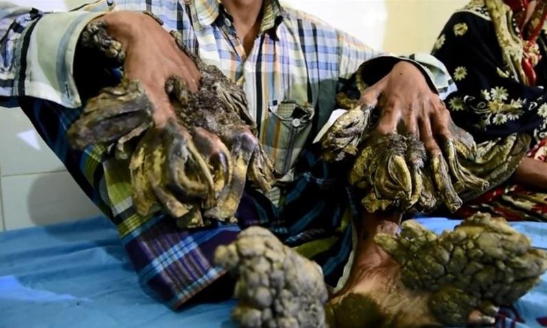 Bengal&ecirc;s removeu cinco quilos de verrugas, semelhantes a cascas, dos p&eacute;s e m&atilde;os