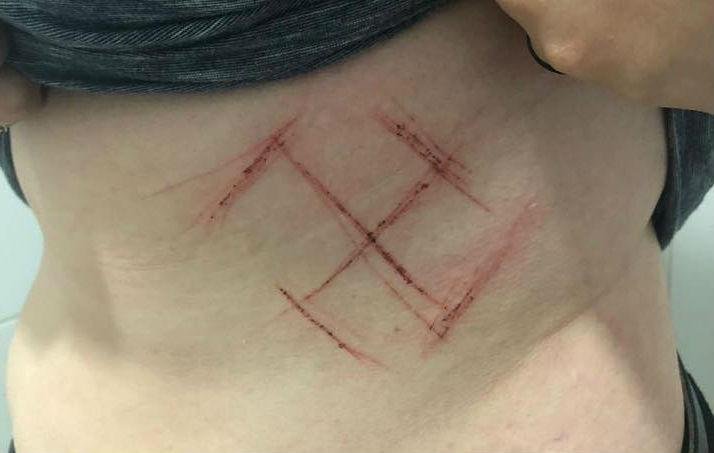 S&iacute;mbolo foi marcado com um canivete na barriga da jovem