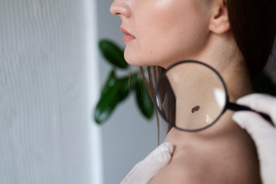 Autoexame e o uso de aplicativos n&atilde;o substituem a consulta ao dermatologista, mas incentivam o paciente a ficar atento &agrave; pr&oacute;pria pele