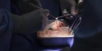 Equipe médica nos EUA anuncia primeiro transplante de rim de porco a um paciente vivo