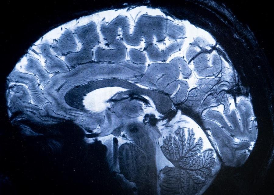 Campo magn&eacute;tico criado pelo scanner &eacute; de 11,7 teslas