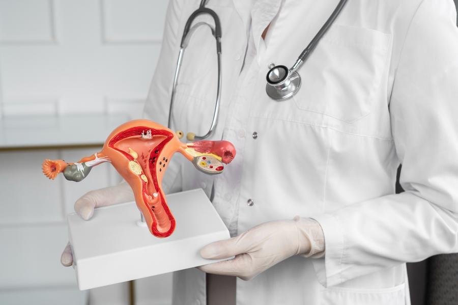 Novas evid&ecirc;ncias indicam que cirurgia conhecida como salpingectomia pode atuar na preven&ccedil;&atilde;o
