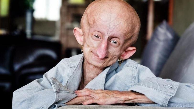 A influencer Beandri Booysen foi diagnosticada com S&iacute;ndrome de Hutchinson-Gilford