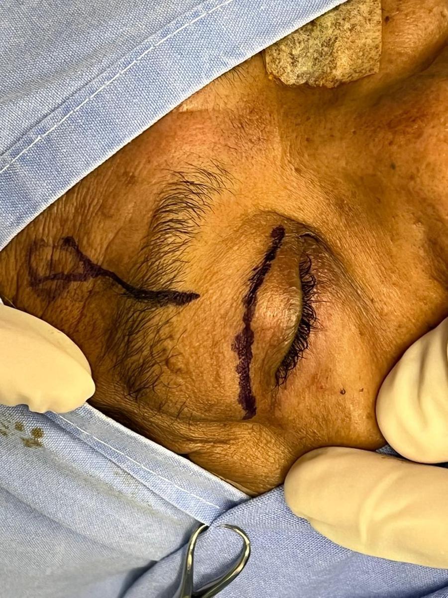 Cirurgia in&eacute;dita via SUS no Brasil foi realizada no Hospital de Cl&iacute;nicas de Porto Alegre