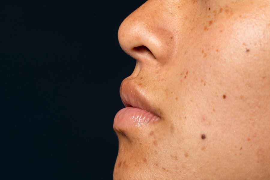 O melasma &eacute; uma doen&ccedil;a de pele benigna, mas emocionalmente angustiante