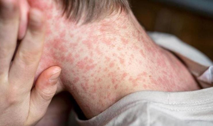 Pensilv&acirc;nia registrou cinco mortes e quase 200 interna&ccedil;&otilde;es&nbsp;relacionadas ao sarampo