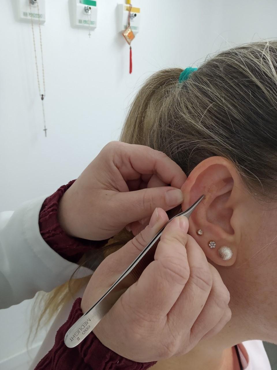 A t&eacute;cnica consiste em utilizar pontos nas orelhas para tratamento de diversos sinais e sintomas comuns em diferentes patologias