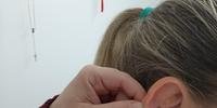A técnica consiste em utilizar pontos nas orelhas para tratamento de diversos sinais e sintomas comuns em diferentes patologias