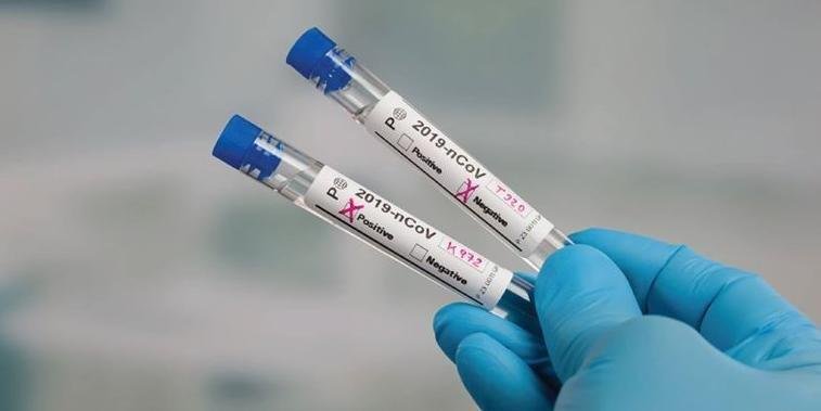Diagn&oacute;sticos para coronav&iacute;rus foram confirmados por meio de testes r&aacute;pidos