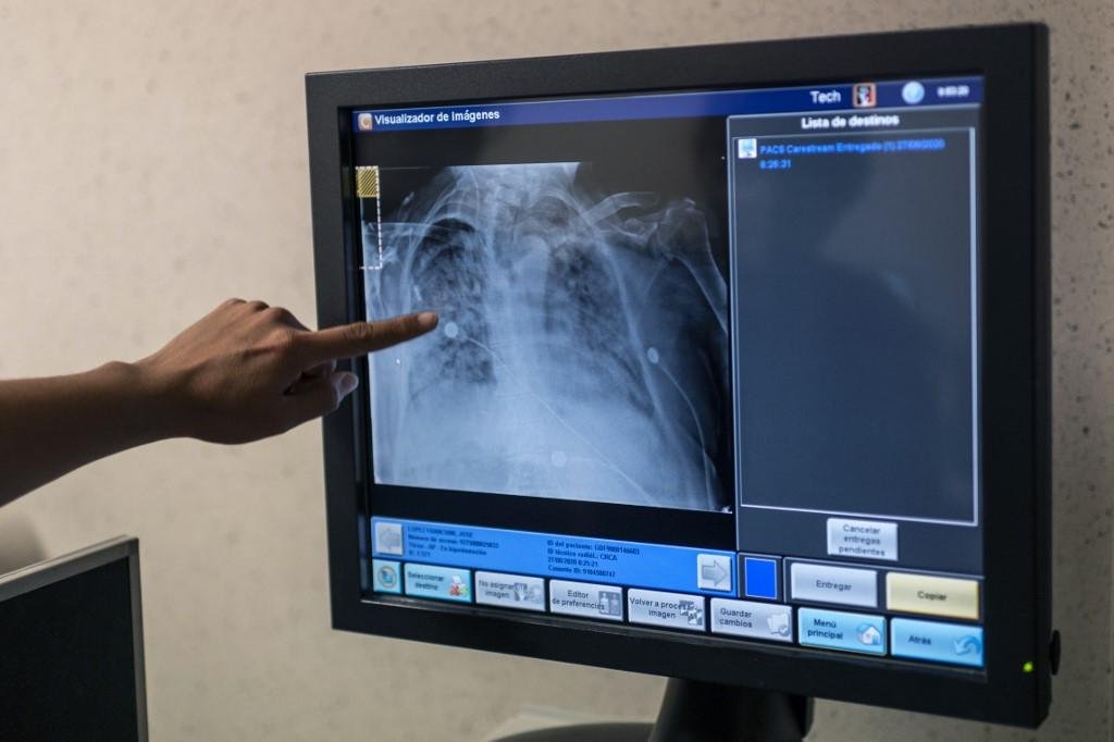 Infec&ccedil;&atilde;o pode provocar graves inflama&ccedil;&otilde;es respirat&oacute;rias