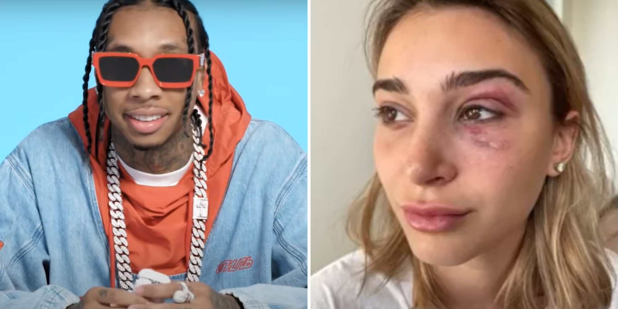 Ex-namorada de Tyga exibiu hematomas no olho