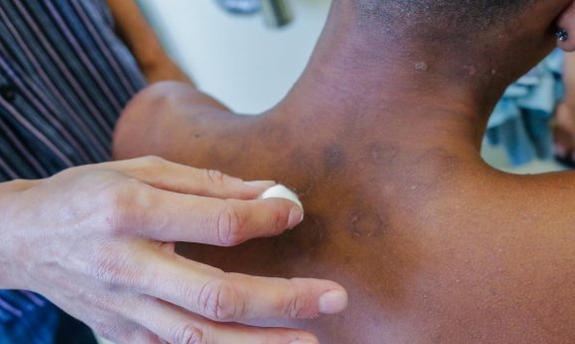 Hansen&iacute;ase atinge pele e nervos e gera redu&ccedil;&atilde;o da for&ccedil;a muscular