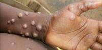 Casos de varíola do macaco têm sido registrados em alguns países africanos