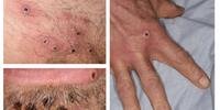 Doença contagiosa provoca erupções na pele