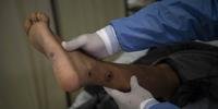 Ao menos 20 cidades do RS já registram casos de varíola do macaco