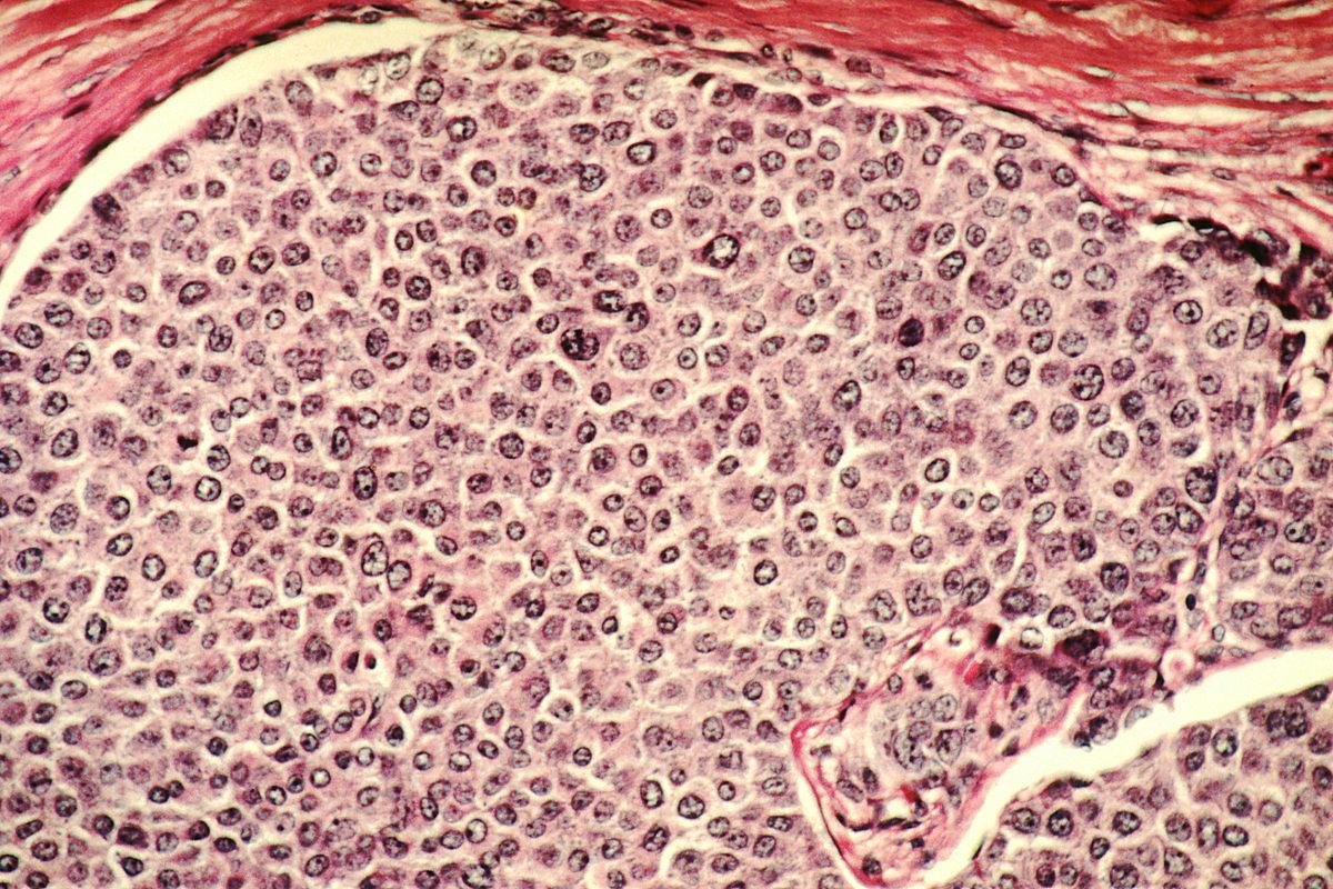Imunizante precisa identificar diversas prote&iacute;nas das c&eacute;lulas cancerosas