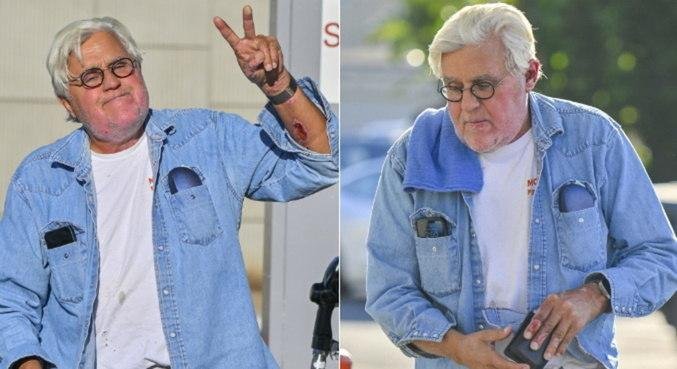 Apresentador Jay Leno exibiu queimaduras nos bra&ccedil;os, m&atilde;os e rosto